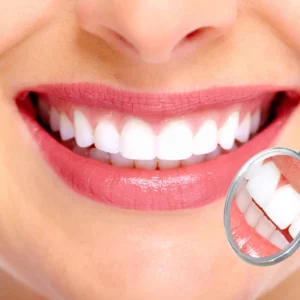 Diseño de Sonrisa – Blanqueamiento + Alineación