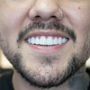 Diseño de Sonrisa Estratificado en Resina