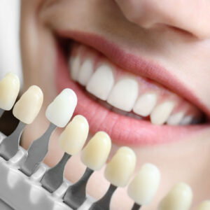 Diseño de Sonrisa en Cerámica Dental – Superior e Inferior