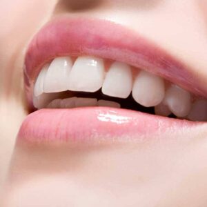 Diseño de Sonrisa en Cerámica Dental – Superior