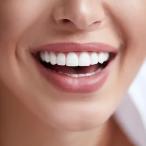 Diseño de Sonrisa en Resina de Alta Estética