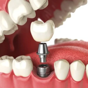 Implantes Dentales