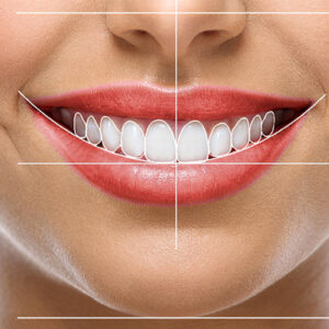 Diseño de Sonrisa – Alineación de Bordes