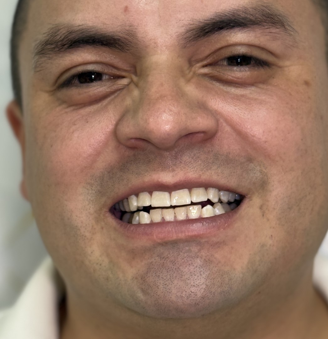 Antes
